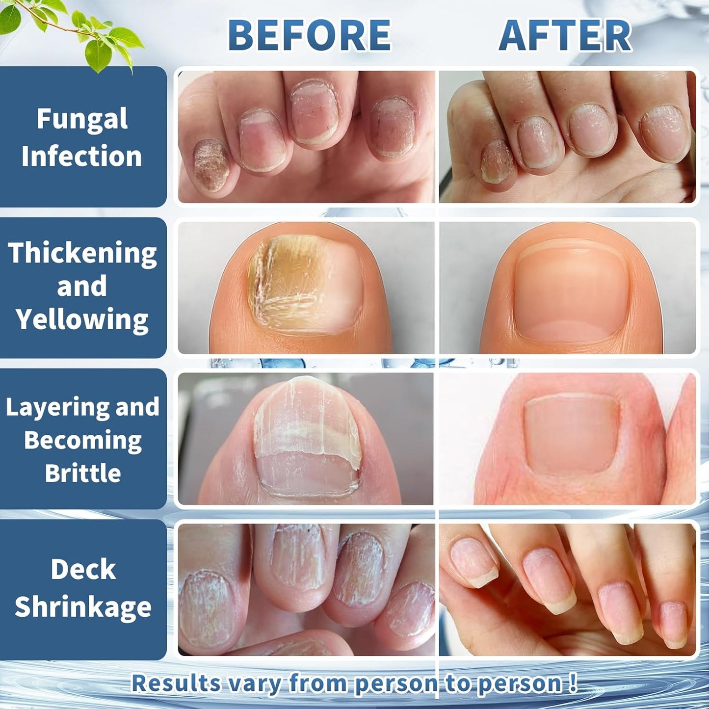 Extra Strength Nail Fungus Treatment – Triple Action Formula Repairs Thick, Yellow & Damaged Nails Fast